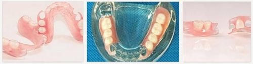 Частичный зубной съемный протез