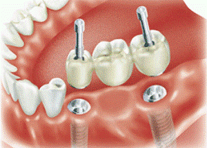 Несъемный вид протезирования зубов: фото